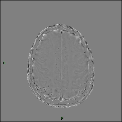 File:Cerebral amyloid angiopathy (Radiopaedia 77506-89664 H 77).jpg