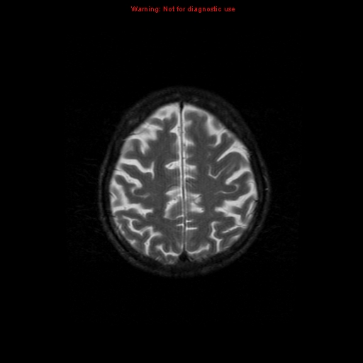 File:Cerebral and orbital tuberculomas (Radiopaedia 13308-13311 Axial T2 17).jpg
