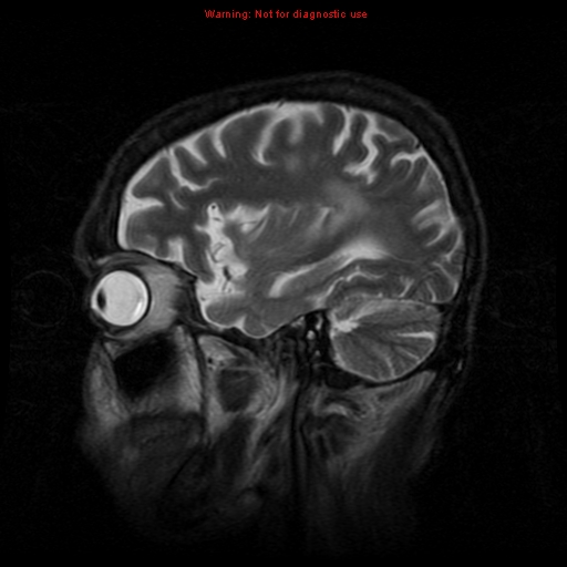File:Cerebral and orbital tuberculomas (Radiopaedia 13308-13311 Sagittal T2 5).jpg