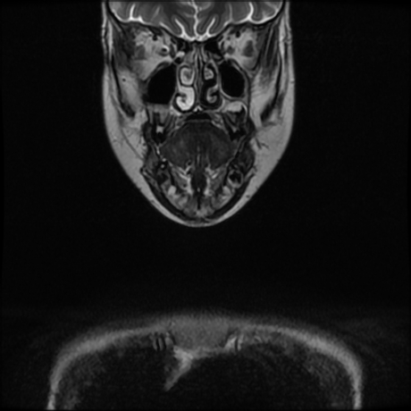 File:Cerebral and spinal tuberculosis (Radiopaedia 90489-107838 Coronal 20).jpg