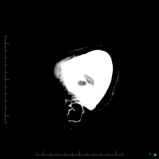 Cerebral arteriovenous malformation (AVM) (Radiopaedia 78162-90706 A 6).jpg
