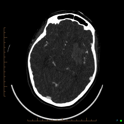 Cerebral arteriovenous malformation (AVM) (Radiopaedia 78162-90706 Axial CTA 128).jpg
