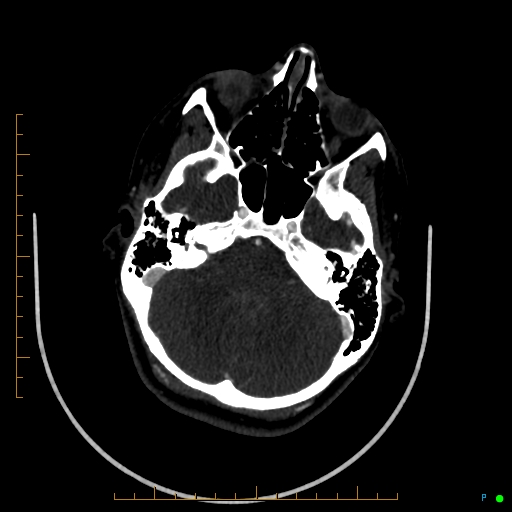 Cerebral arteriovenous malformation (AVM) (Radiopaedia 78162-90706 Axial CTA 81).jpg