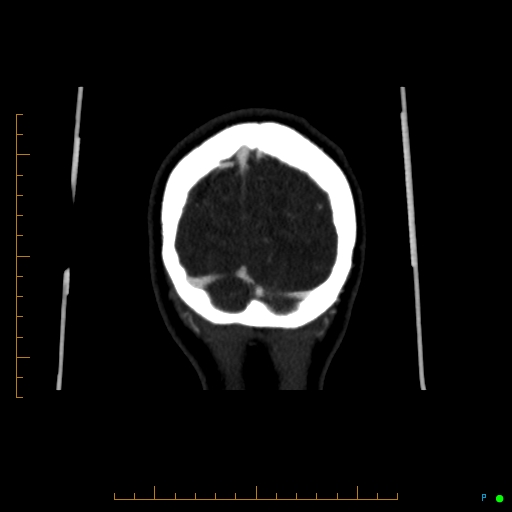 Cerebral arteriovenous malformation (AVM) (Radiopaedia 78162-90706 Coronal CTA 14).jpg