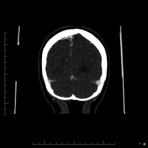 Cerebral arteriovenous malformation (AVM) (Radiopaedia 78162-90706 Coronal CTA 20).jpg
