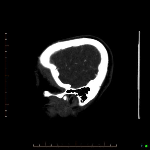 Cerebral arteriovenous malformation (AVM) (Radiopaedia 78162-90706 Sagittal CTA 69).jpg