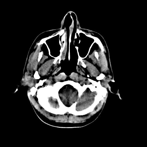 Cerebral arteriovenous malformation (Radiopaedia 28518-28759 Axial non-contrast 7).jpg