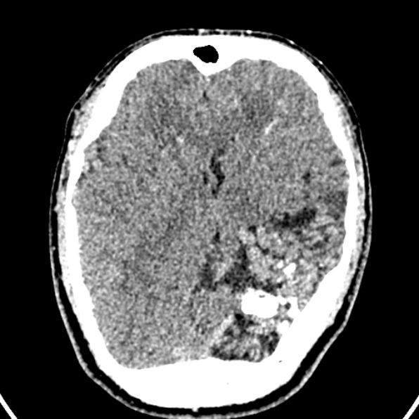 Cerebral arteriovenous malformation (Radiopaedia 37182-39012 Axial non-contrast 23).jpg