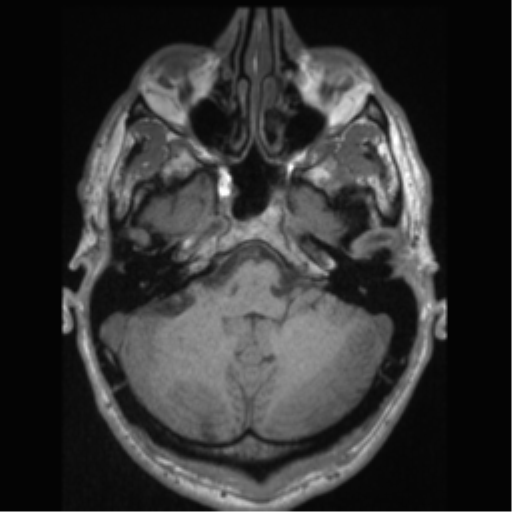Cerebral arteriovenous malformation (Radiopaedia 55798-62372 Axial T1 11).png
