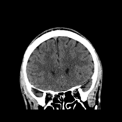 Cerebral arteriovenous malformation (Radiopaedia 61964-70028 Coronal non-contrast 19).jpg