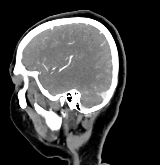 Cerebral arteriovenous malformation (Radiopaedia 73830-84645 D 21).jpg