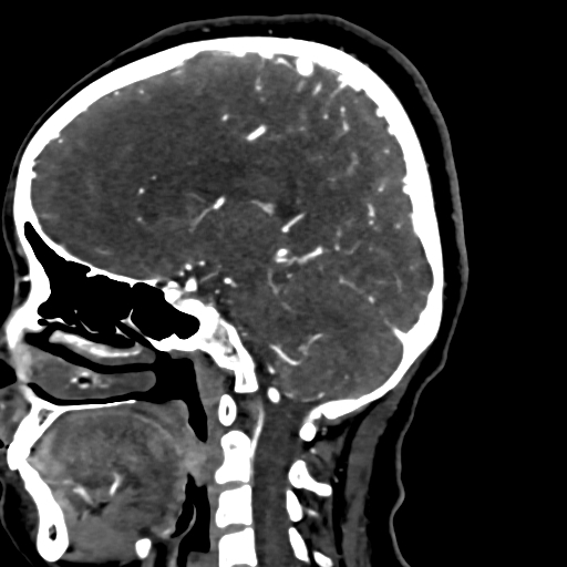 Cerebral arteriovenous malformation (Radiopaedia 73830-84645 Sagittal C+ delayed 52).jpg