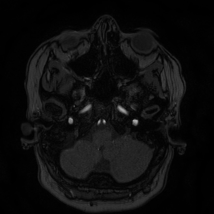 Cerebral arteriovenous malformation (Radiopaedia 74411-85654 Axial MRA 7).jpg