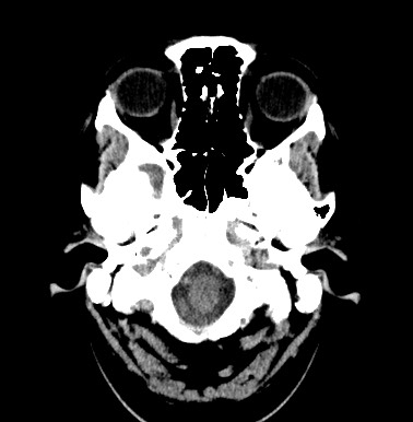 File:Cerebral arteriovenous malformation (Radiopaedia 74411-85744 Axial non-contrast 2).jpg