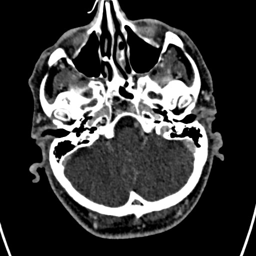 Cerebral arteriovenous malformation (Radiopaedia 78188-90746 Axial C+ delayed 34).jpg