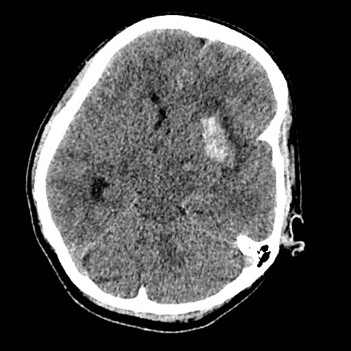 Cerebral arteriovenous malformation (Radiopaedia 79677-92887 Axial non-contrast 15).jpg
