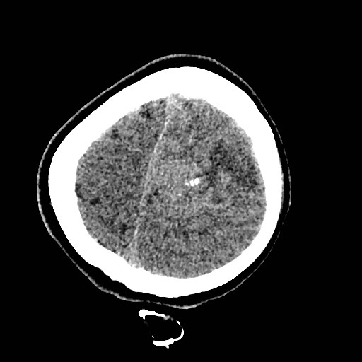 Cerebral arteriovenous malformation (Radiopaedia 79677-92887 Axial non-contrast 49).jpg
