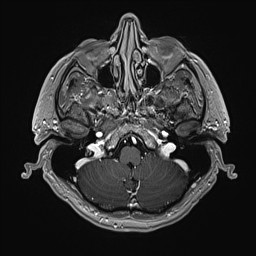 Cerebral arteriovenous malformation (Radiopaedia 84015-99245 Axial T1 C+ 35).jpg