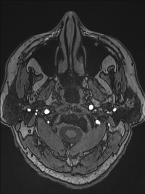 Cerebral arteriovenous malformation (Radiopaedia 84015-99245 Axial TOF 20).jpg