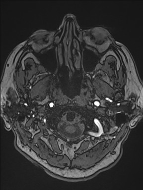 File:Cerebral arteriovenous malformation (Radiopaedia 84015-99245 Axial TOF 38).jpg