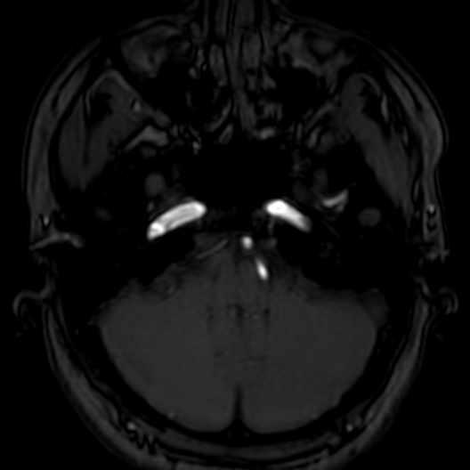 Cerebral arteriovenous malformation at posterior body of corpus callosum (Radiopaedia 74111-84925 Axial MRA 35).jpg