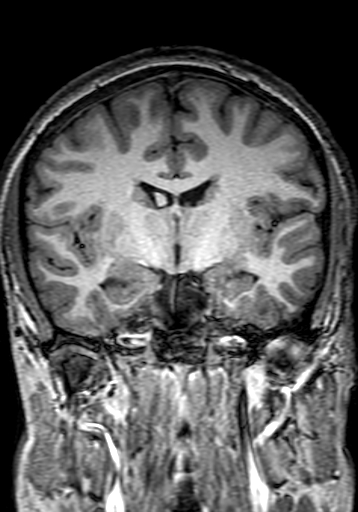 Cerebral arteriovenous malformation at posterior body of corpus callosum (Radiopaedia 74111-84925 Coronal T1 154).jpg
