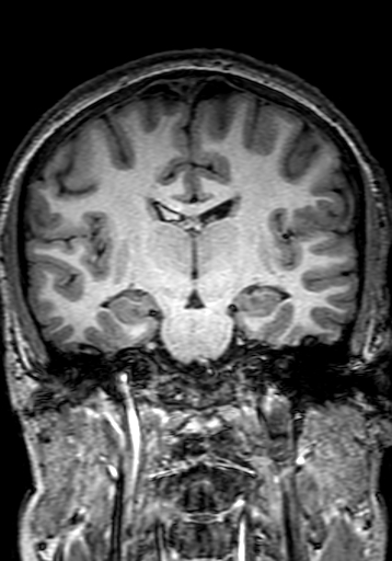 File:Cerebral arteriovenous malformation at posterior body of corpus callosum (Radiopaedia 74111-84925 Coronal T1 172).jpg