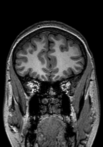 File:Cerebral arteriovenous malformation at posterior body of corpus callosum (Radiopaedia 74111-84925 Coronal T1 58).jpg