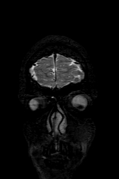 Cerebral arteriovenous malformation at posterior body of corpus callosum (Radiopaedia 74111-84925 Coronal T2 6).jpg