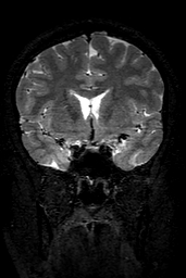 Cerebral arteriovenous malformation at posterior body of corpus callosum (Radiopaedia 74111-84925 Coronal T2 66).jpg