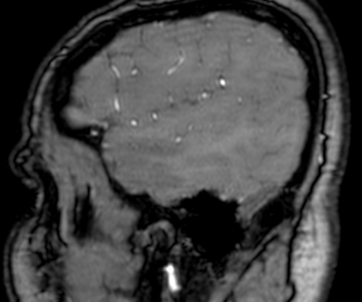 Cerebral arteriovenous malformation at posterior body of corpus callosum (Radiopaedia 74111-84925 J 37).jpg