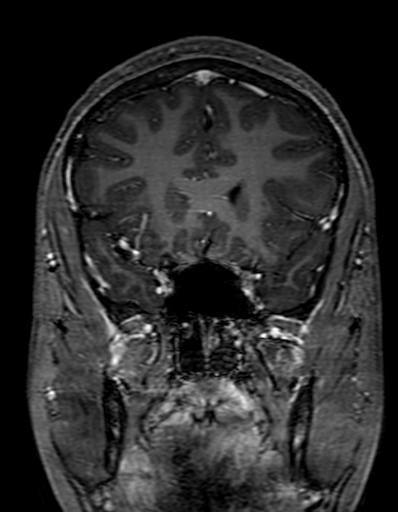 Cerebral arteriovenous malformation at posterior body of corpus callosum (Radiopaedia 74111-84925 K 114).jpg