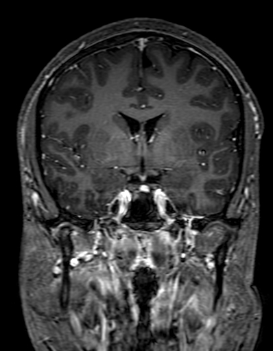 Cerebral arteriovenous malformation at posterior body of corpus callosum (Radiopaedia 74111-84925 K 158).jpg