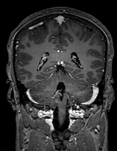 Cerebral arteriovenous malformation at posterior body of corpus callosum (Radiopaedia 74111-84925 K 247).jpg