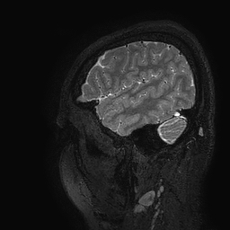Cerebral arteriovenous malformation at posterior body of corpus callosum (Radiopaedia 74111-84925 Sagittal T2 12).jpg
