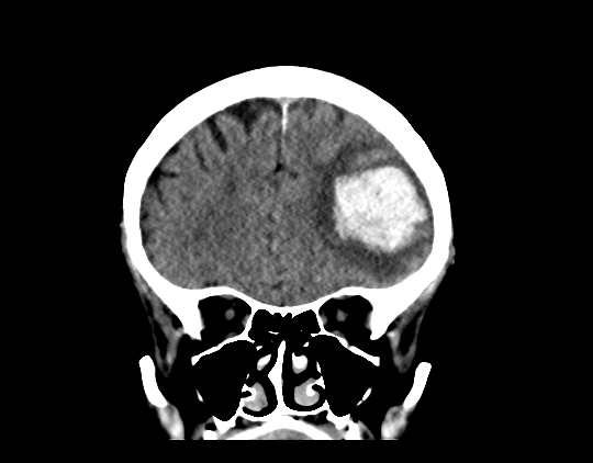 File:Cerebral arteriovenous malformation with lobar hemorrhage (Radiopaedia 44725-48510 Coronal non-contrast 16).png