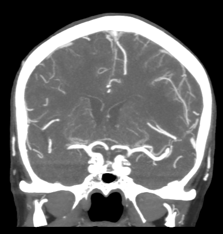 Cerebral arteriovenous malformation with lobar hemorrhage (Radiopaedia 44725-48511 B 25).png