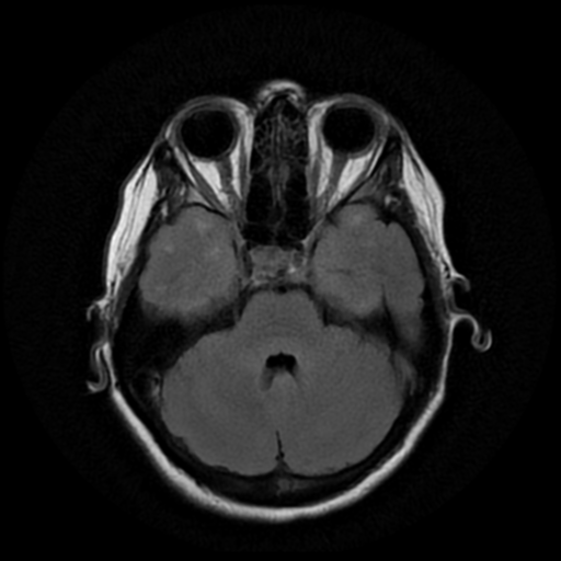 File:Cerebral autosomal dominant arteriopathy with subcortical infarcts and leukoencephalopathy (CADASIL) (Radiopaedia 41018-43768 AX FLAIR (Propeller) 6).png