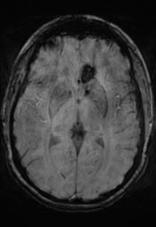 File:Cerebral cavernoma and development venous anomaly (Radiopaedia 37603-39482 Axial SWI 20).png