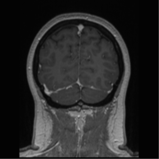 Cerebral cavernoma and development venous anomaly (Radiopaedia 37603-39482 Coronal T1 C+ 19).png