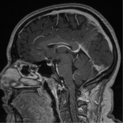 Cerebral cavernoma and development venous anomaly (Radiopaedia 37603-39482 Sagittal T1 C+ 48).png