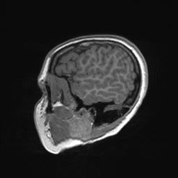 File:Cerebral cavernous venous malformation (Radiopaedia 70008-80021 Sagittal T1 64).jpg