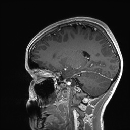 Cerebral cavernous venous malformation (Radiopaedia 70008-80021 Sagittal T1 C+ 27).jpg