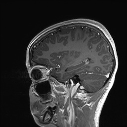 Cerebral cavernous venous malformation (Radiopaedia 70008-80021 Sagittal T1 C+ 51).jpg