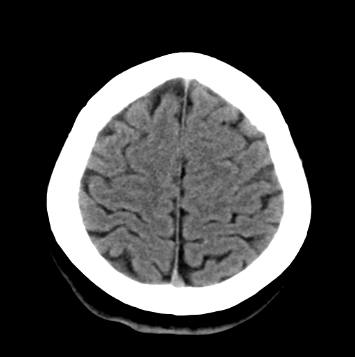 File:Cerebral cavernous venous malformations (Radiopaedia 48117-52945 Axial non-contrast 27).png