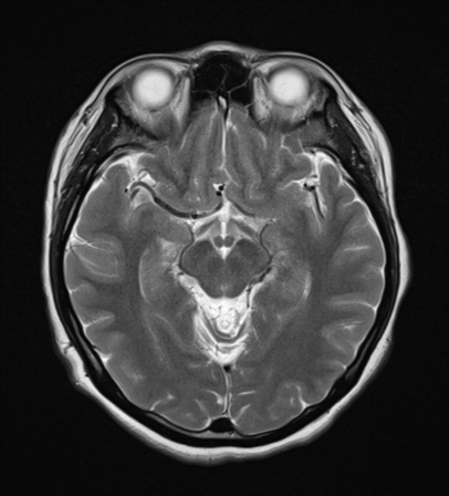 File:Cerebral cavernous venous malformations (Radiopaedia 48117-52946 Axial T2 11).png