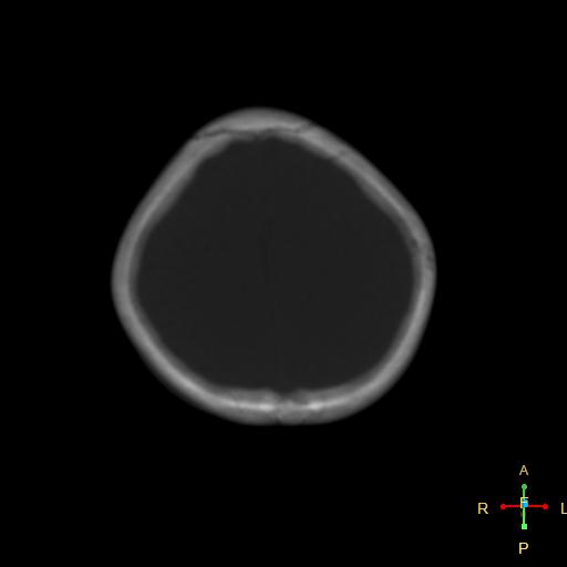 File:Cerebral contusion (Radiopaedia 48869-53911 Axial bone window 4).jpg