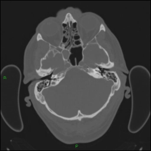 File:Cerebral contusions (Radiopaedia 33868-35039 Axial bone window 40).jpg