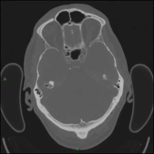 Cerebral contusions (Radiopaedia 33868-35039 Axial bone window 59).jpg