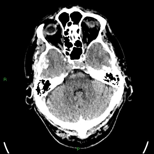 File:Cerebral contusions (Radiopaedia 33868-35039 Axial non-contrast 54).jpg